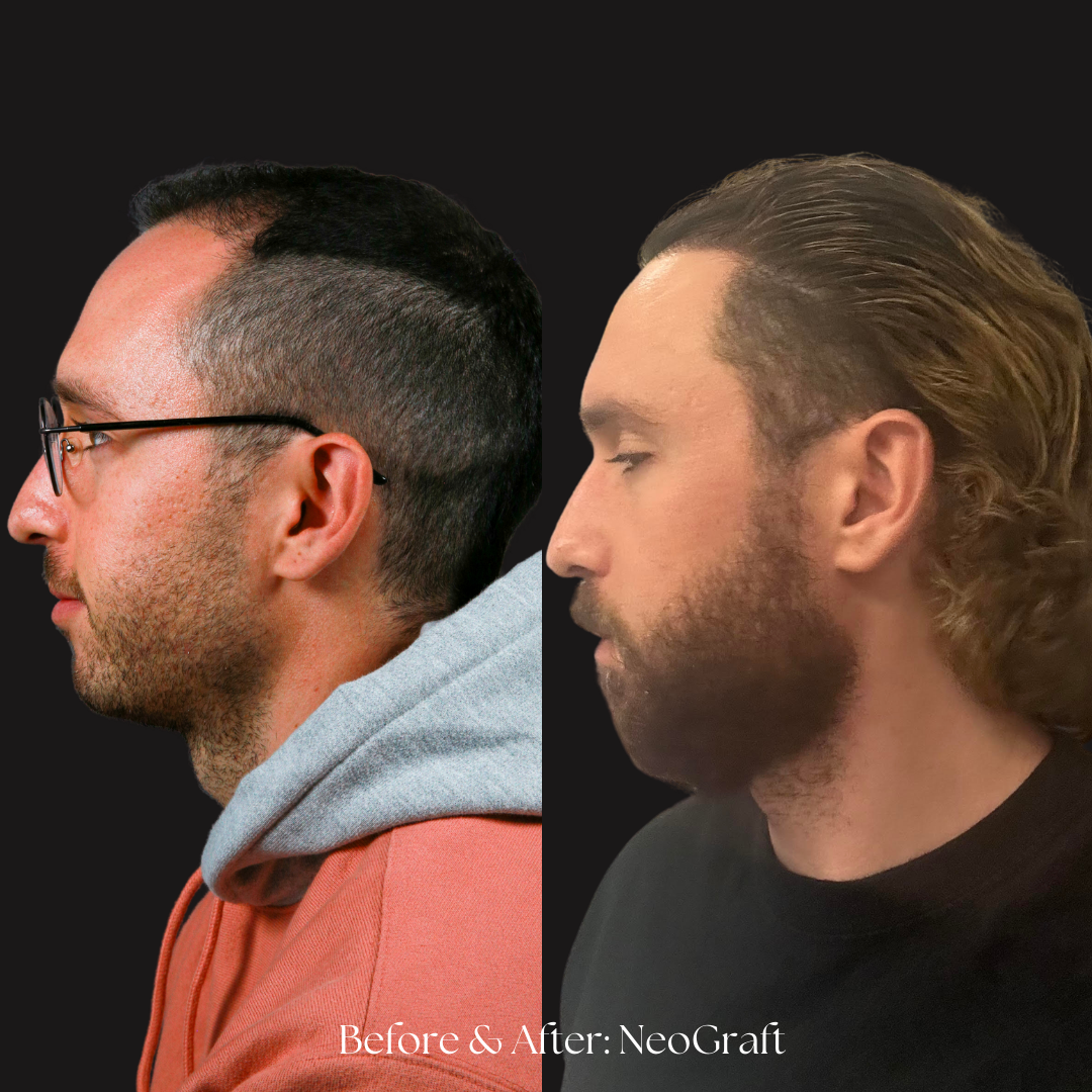 Hair Restoration | NeoGraft Before & After