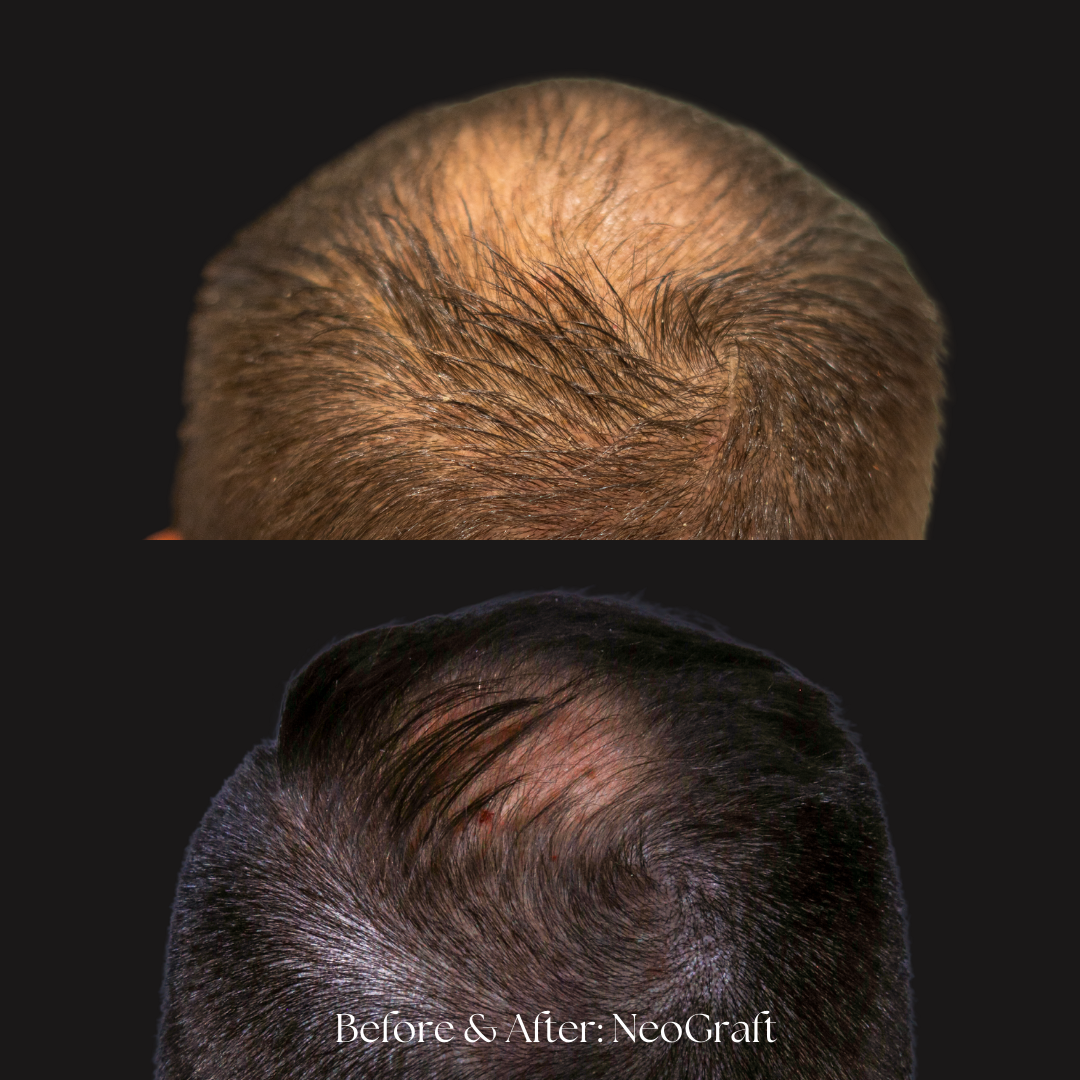 Hair Restoration | NeoGraft Before & After