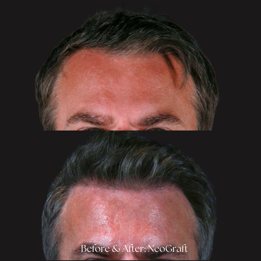 Hair Restoration | NeoGraft Before & After