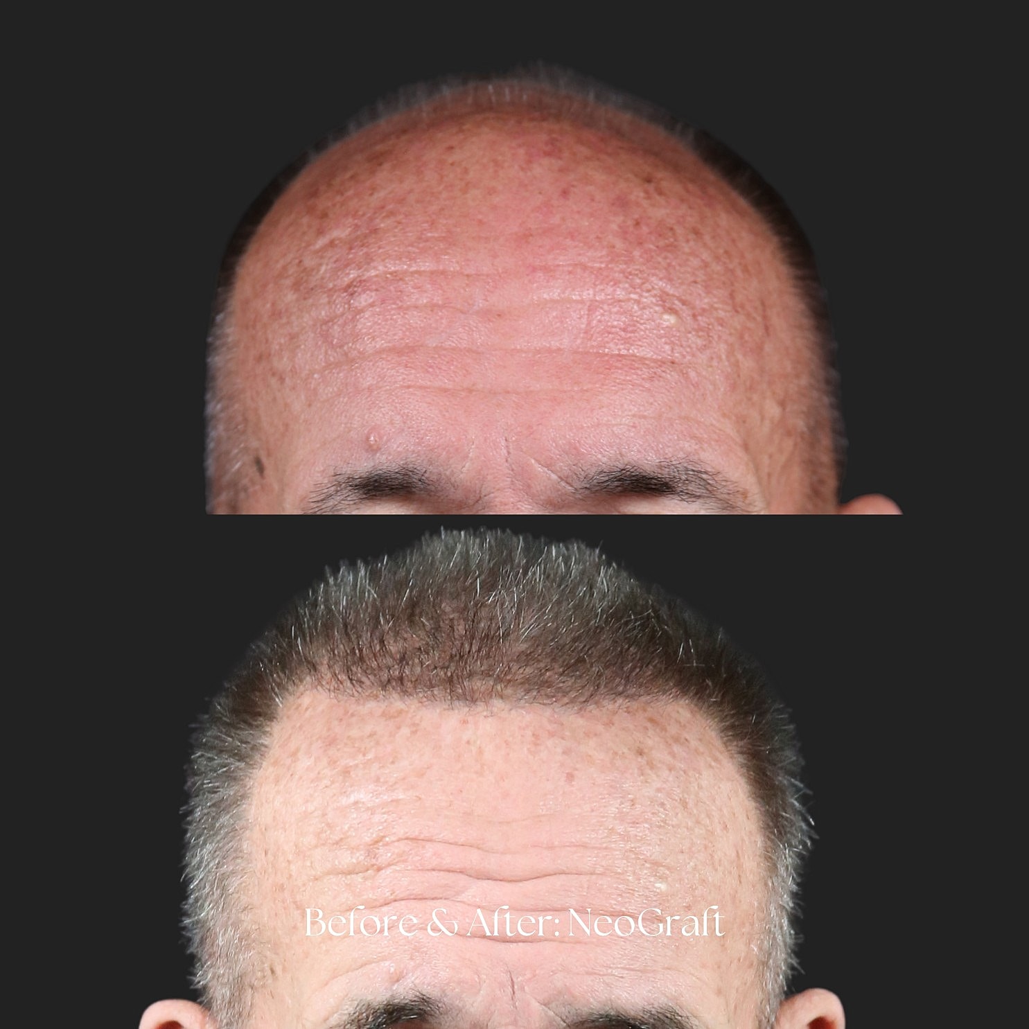 Hair Restoration | NeoGraft Before & After