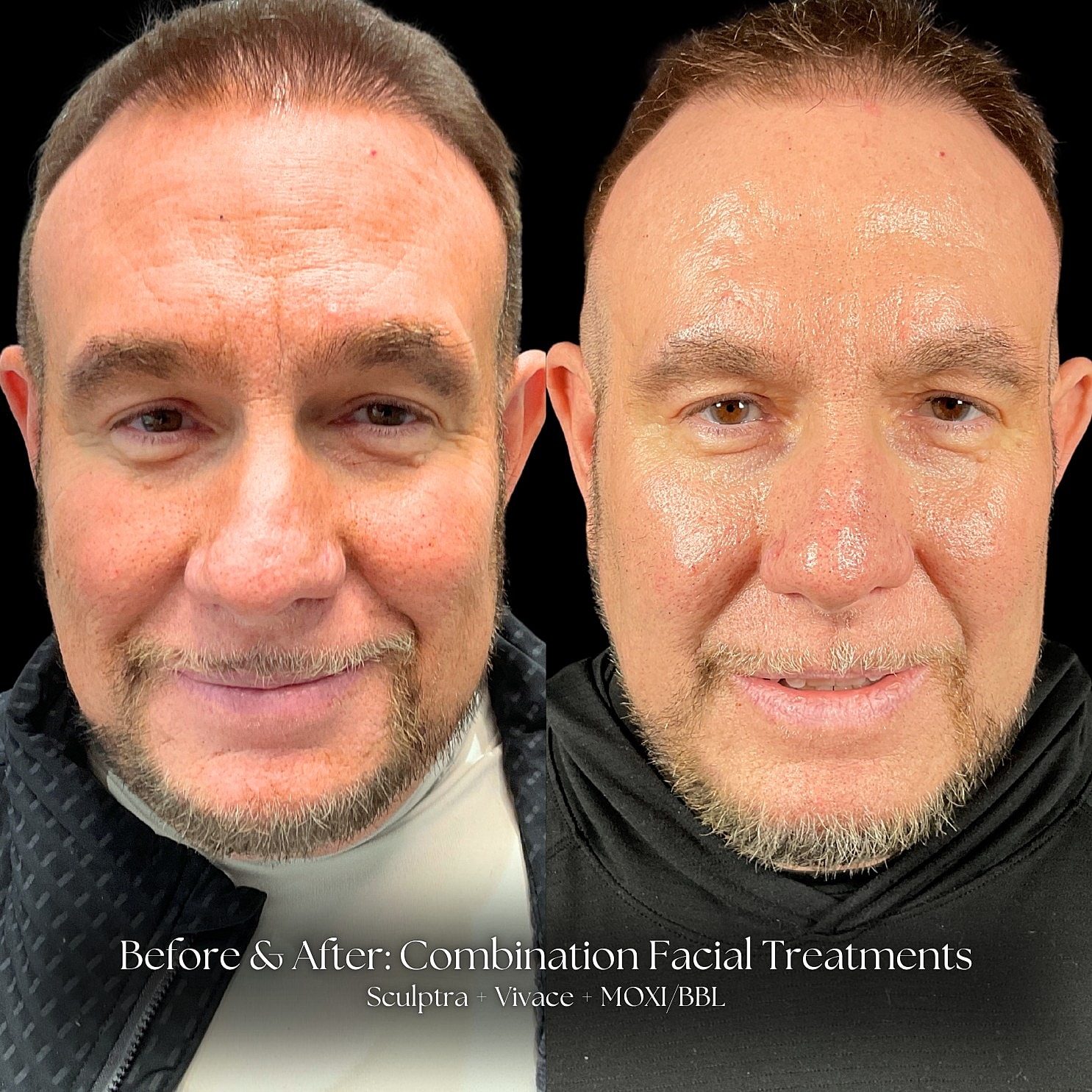 Combination Facial Treatment Before & After
