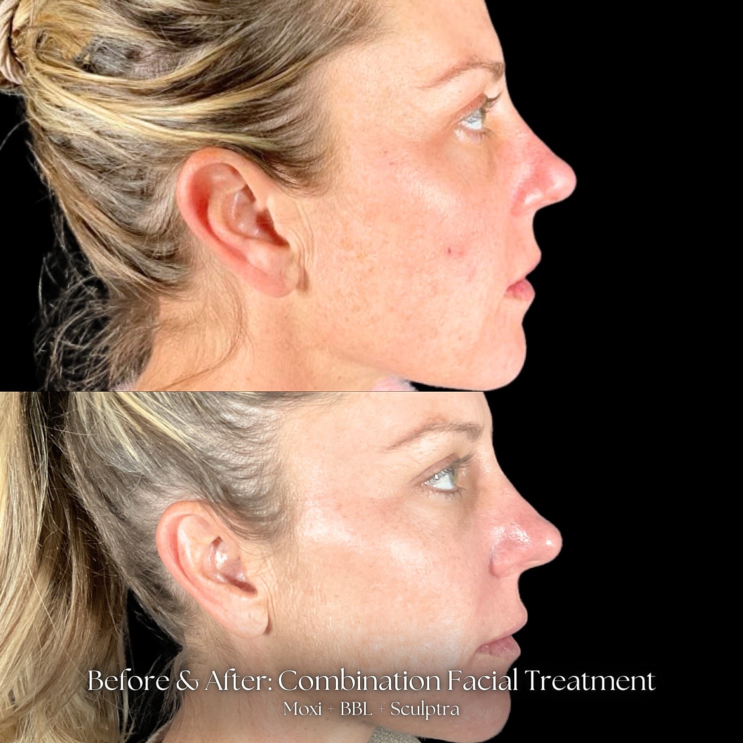 Combination Facial Treatment Before & After