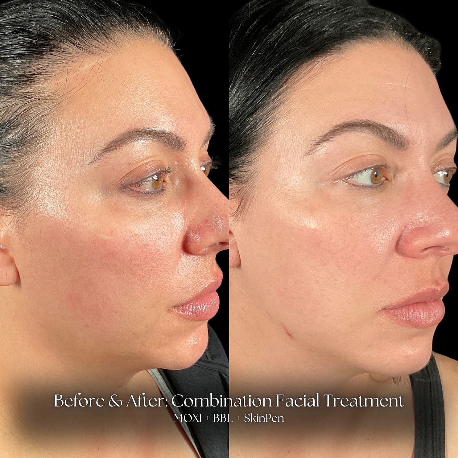 Combination Facial Treatment Before & After