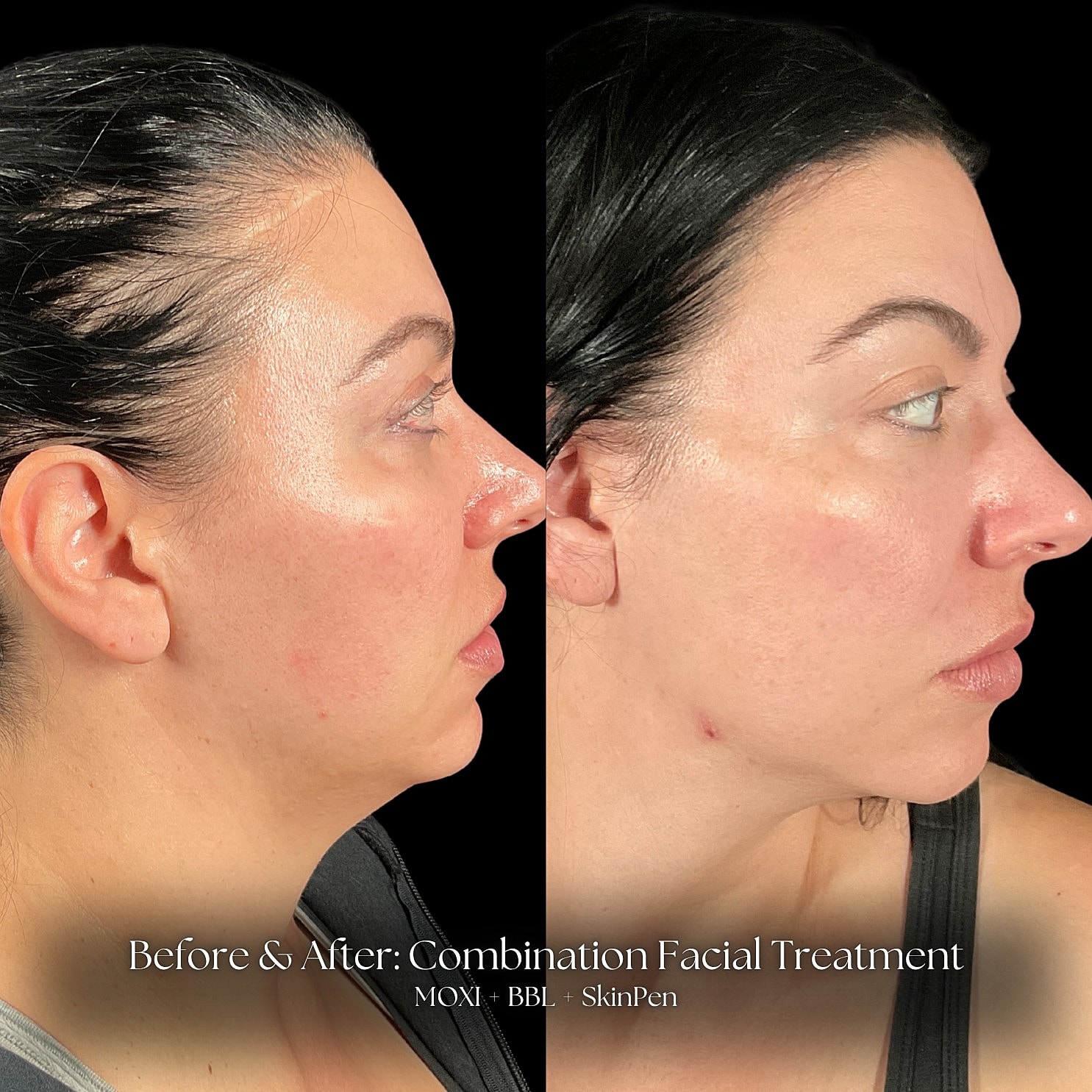 Combination Facial Treatment Before & After