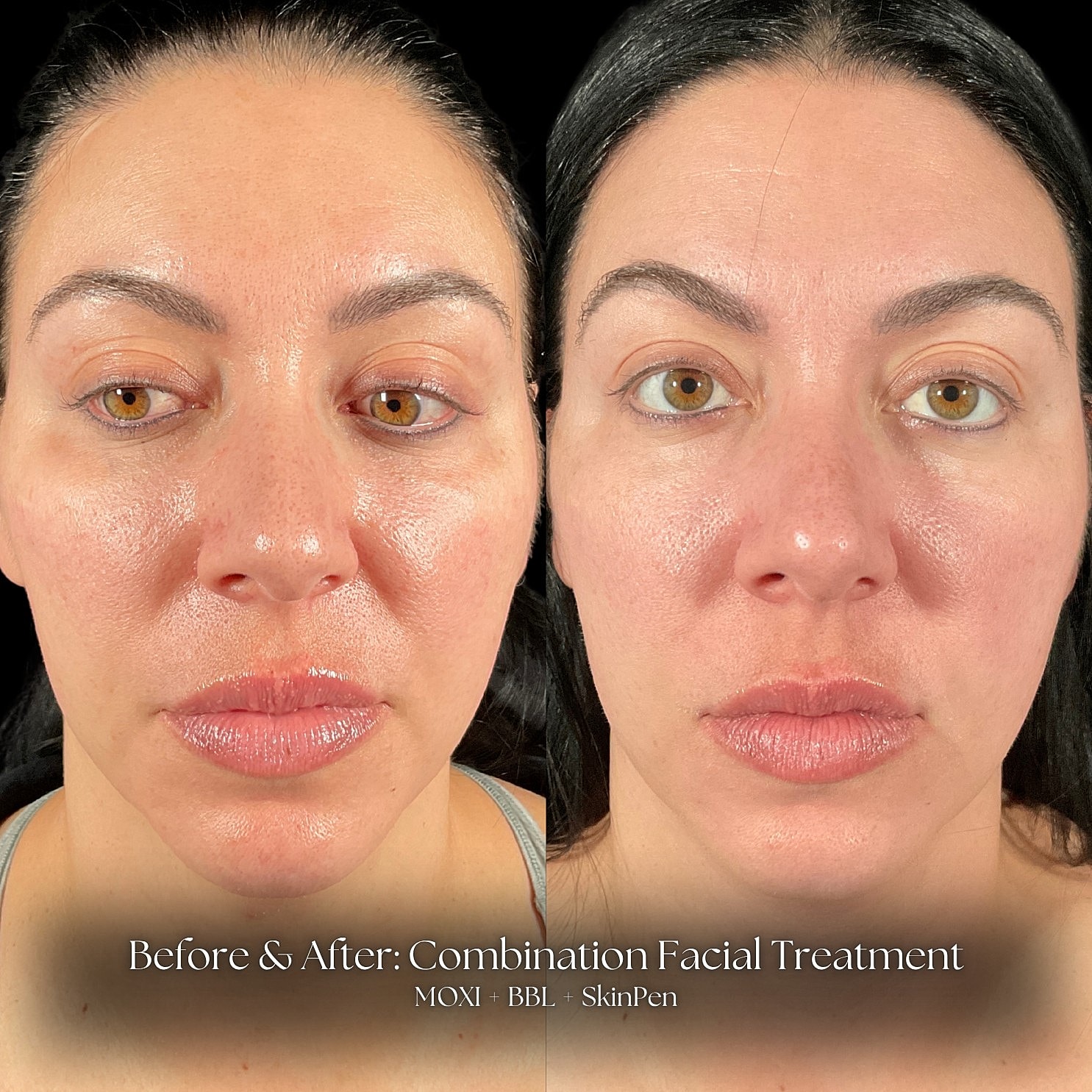 Combination Facial Treatment Before & After