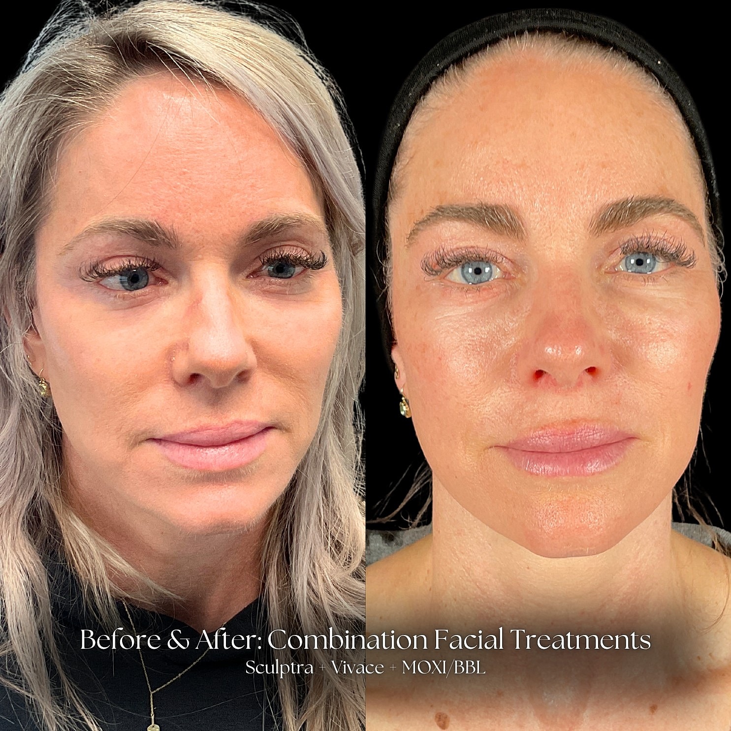 Combination Facial Treatment Before & After