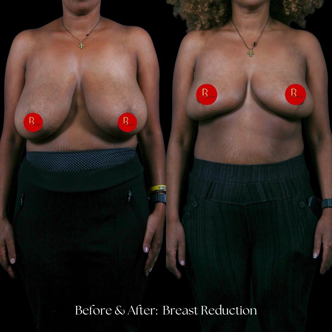 Breast Reduction Before & After