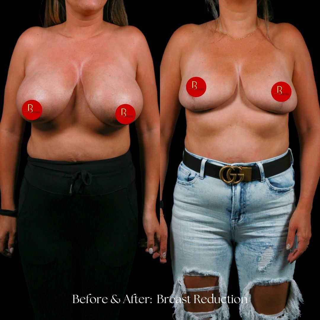 Breast Reduction Before & After