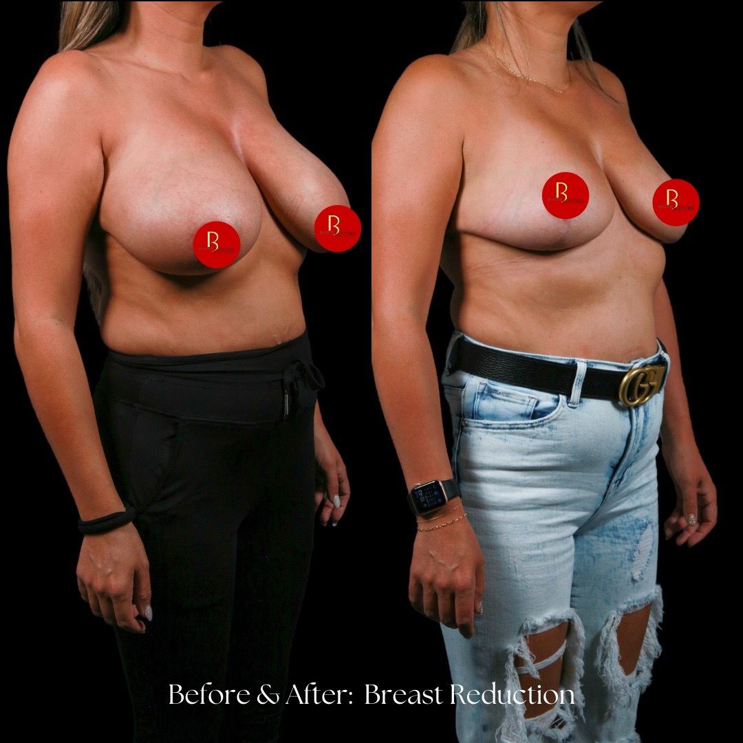 Breast Reduction Before & After