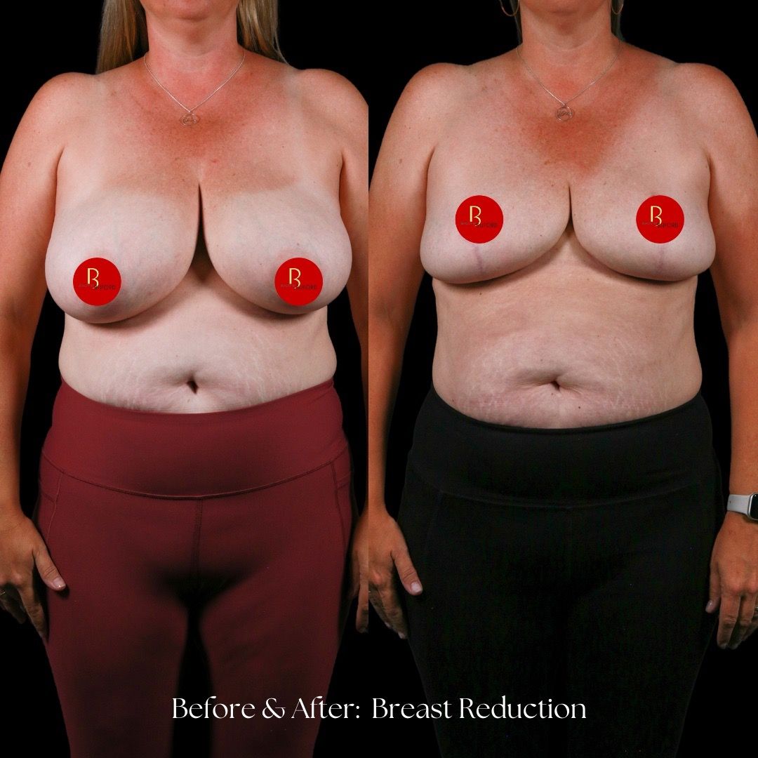 Breast Reduction Before & After