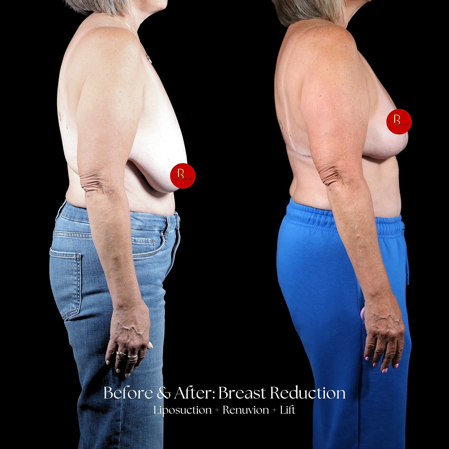 Breast Reduction Before & After