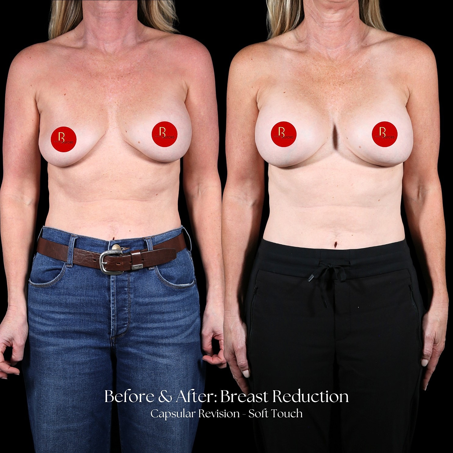 Breast Reduction Before & After