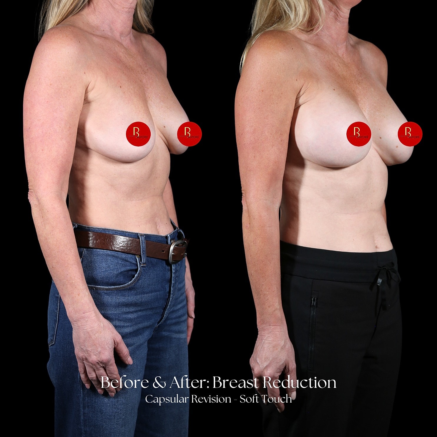 Breast Reduction Before & After