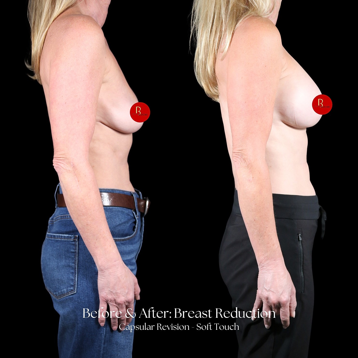 Breast Reduction Before & After