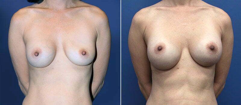 Nipple Reduction Before & After