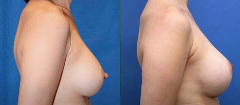 Nipple Reduction Before & After