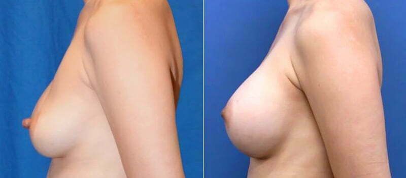 Nipple Reduction Before & After