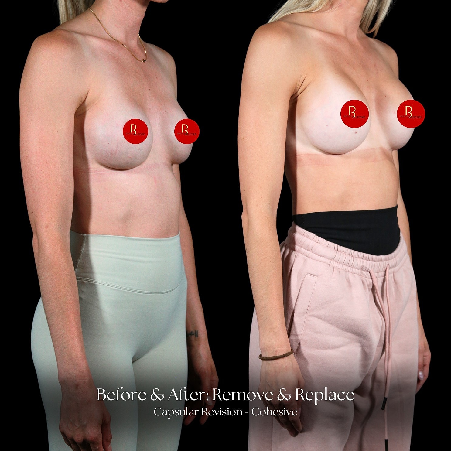 Capsular Revision Before & After