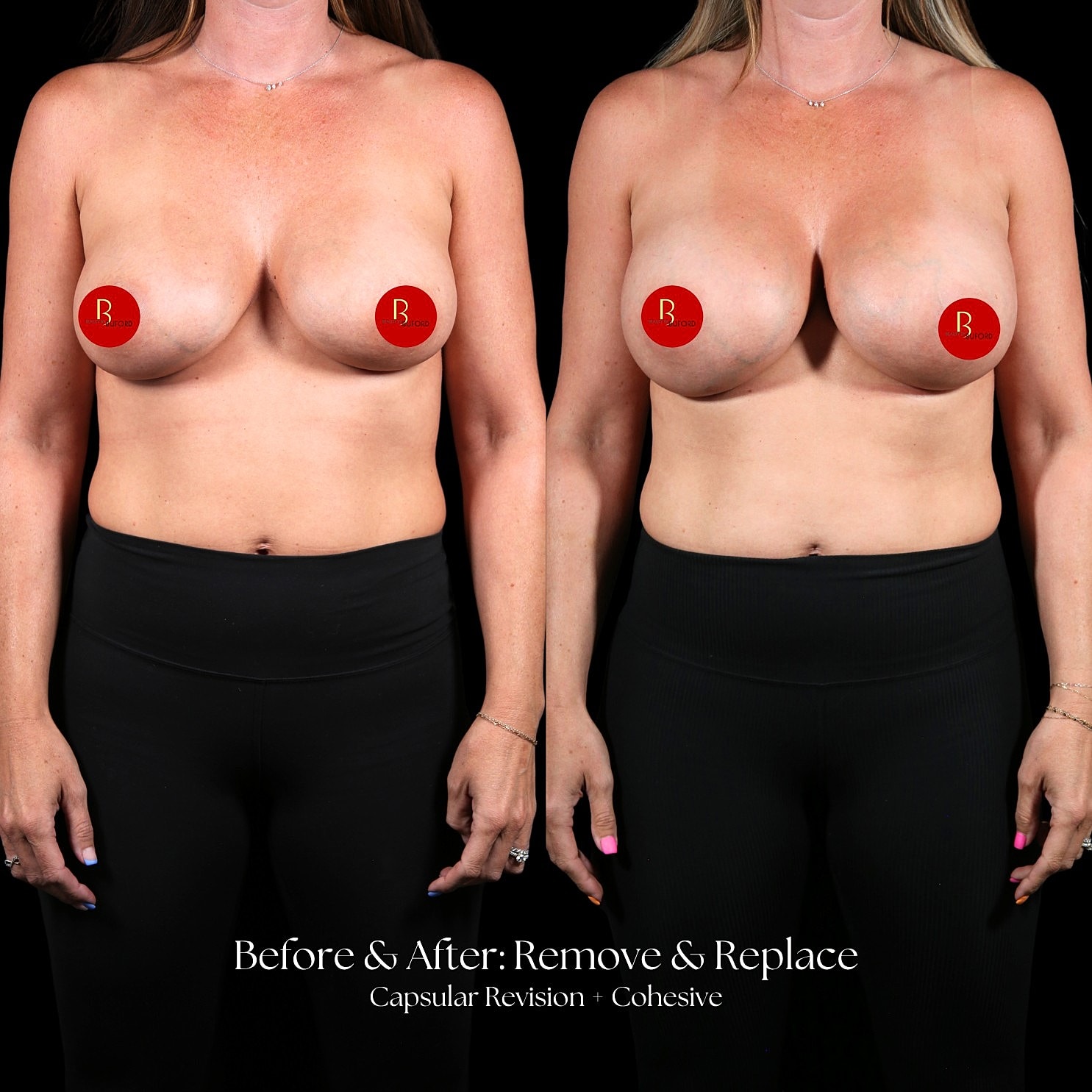 Capsular Revision Before & After