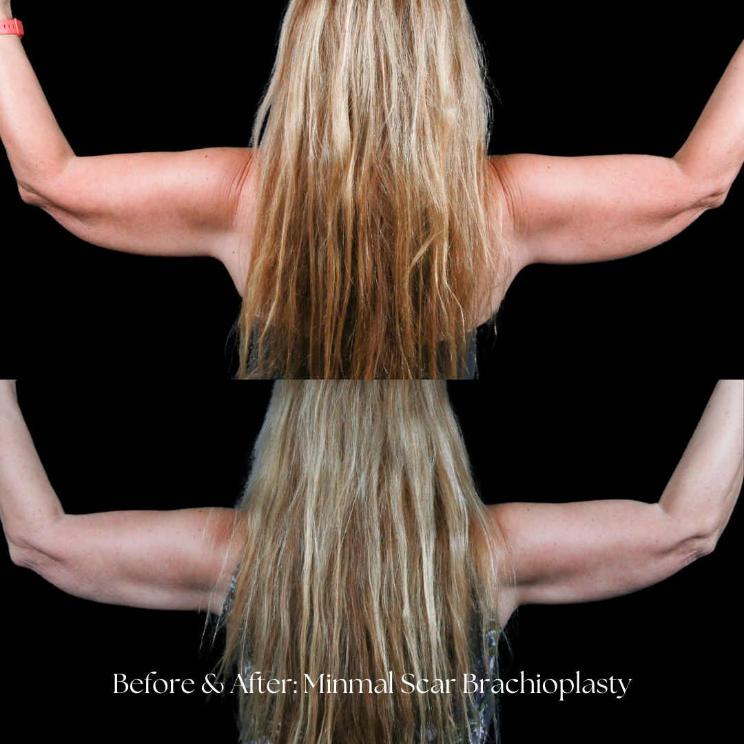 Arm Lift Before & After