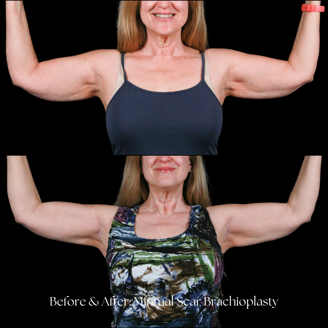 Arm Lift Before & After