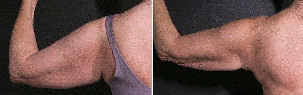 Before and after images of toned arms