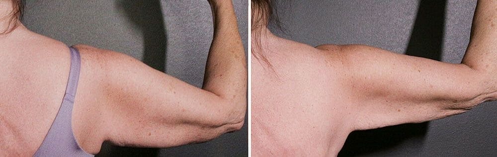 Before and after arm strength comparison photos