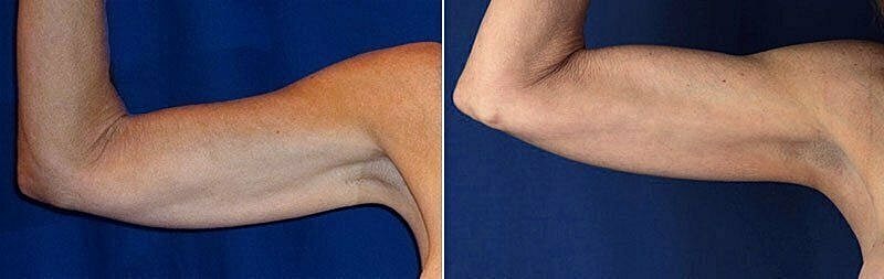 Before and after arm appearance comparison.