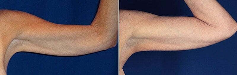 Comparative images of toned versus untoned arms