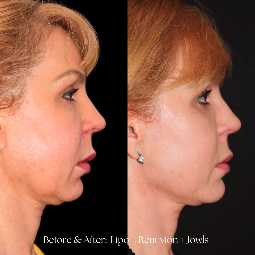 Facial Liposuction Before & After