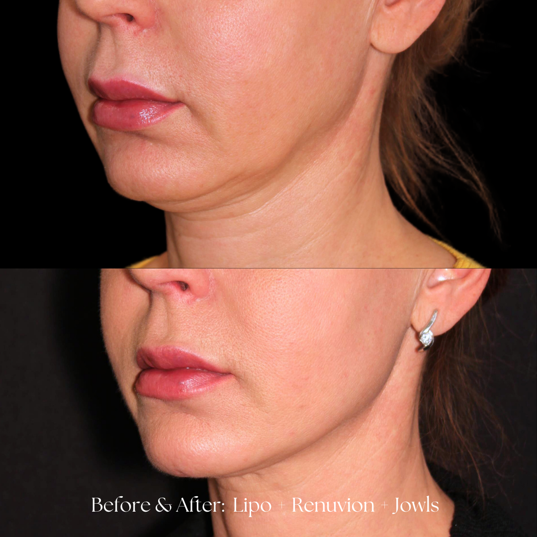 Facial Liposuction Before & After