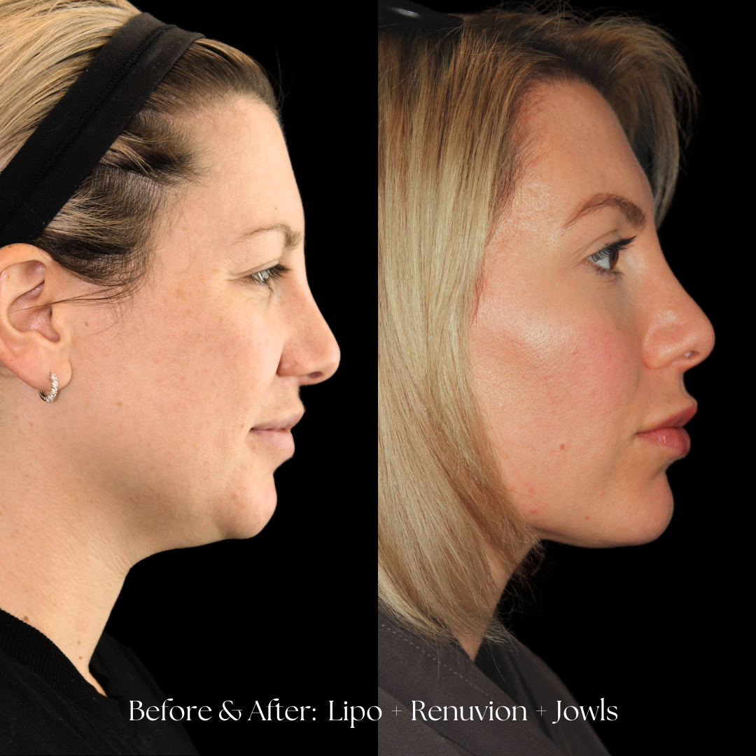 Facial Liposuction Before & After