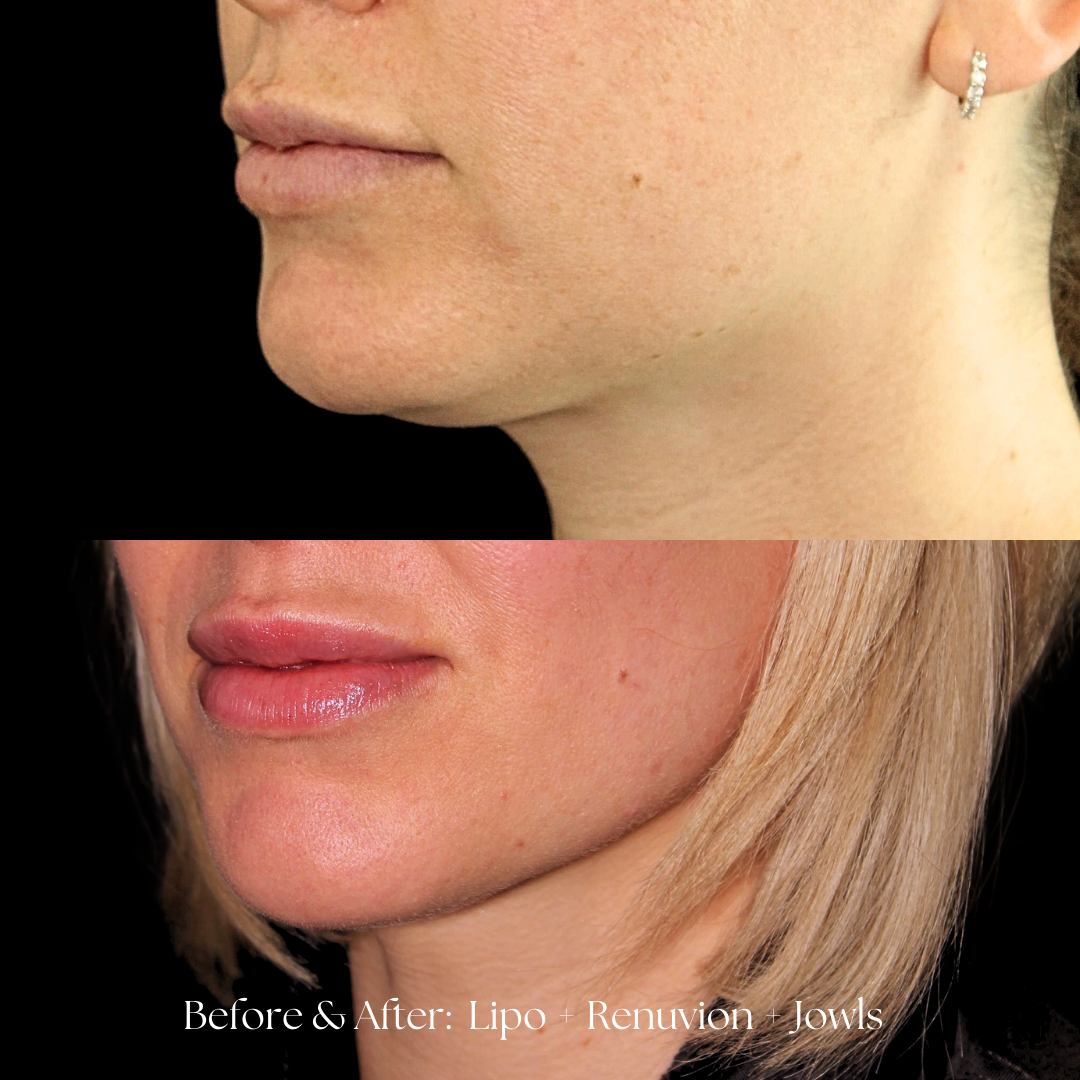 Facial Liposuction Before & After