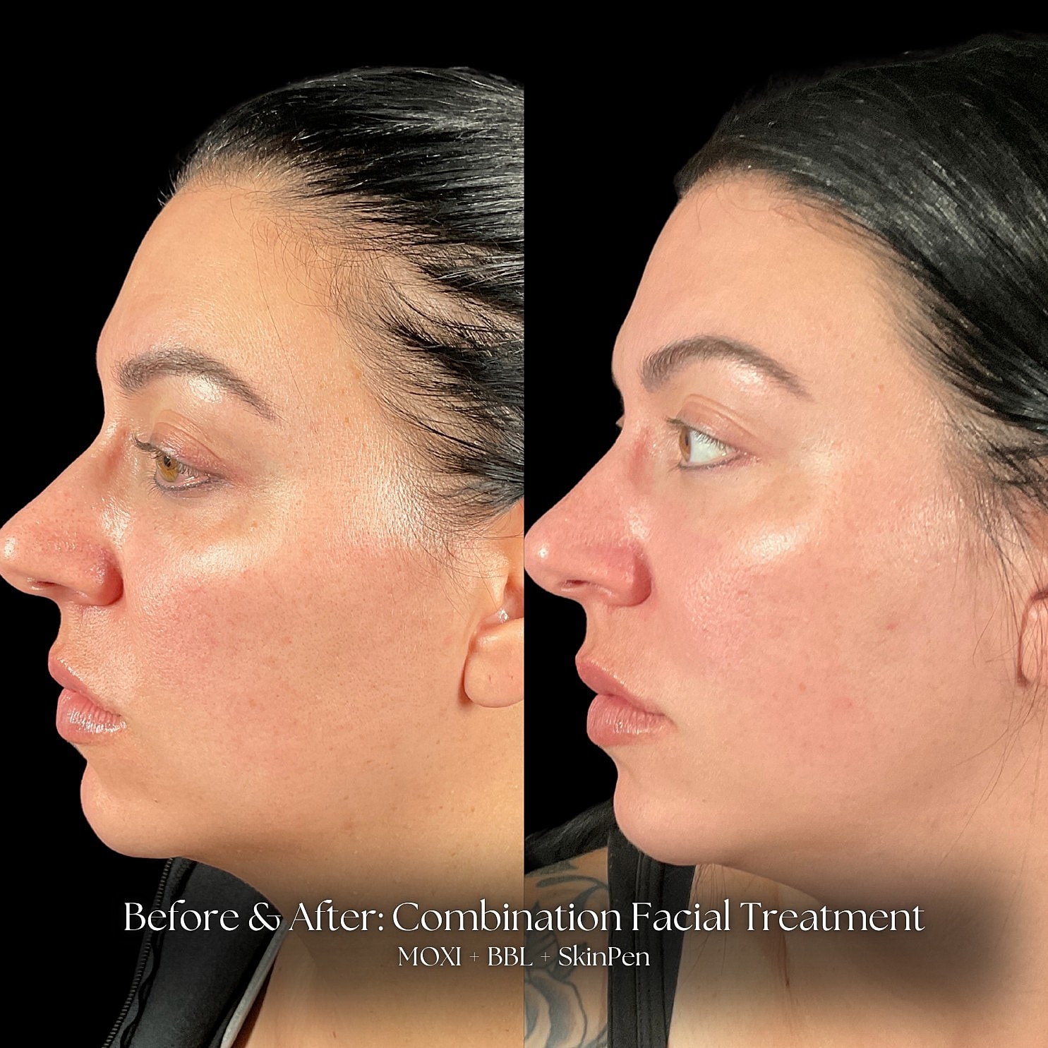 Laser Skin Resurfacing Before & After