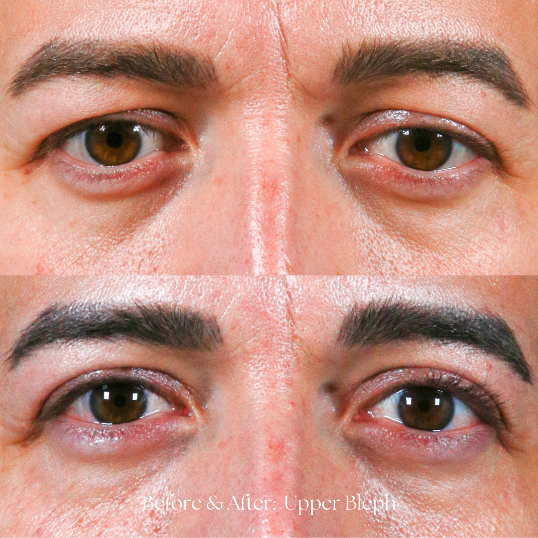Eyelid Lift Before & After
