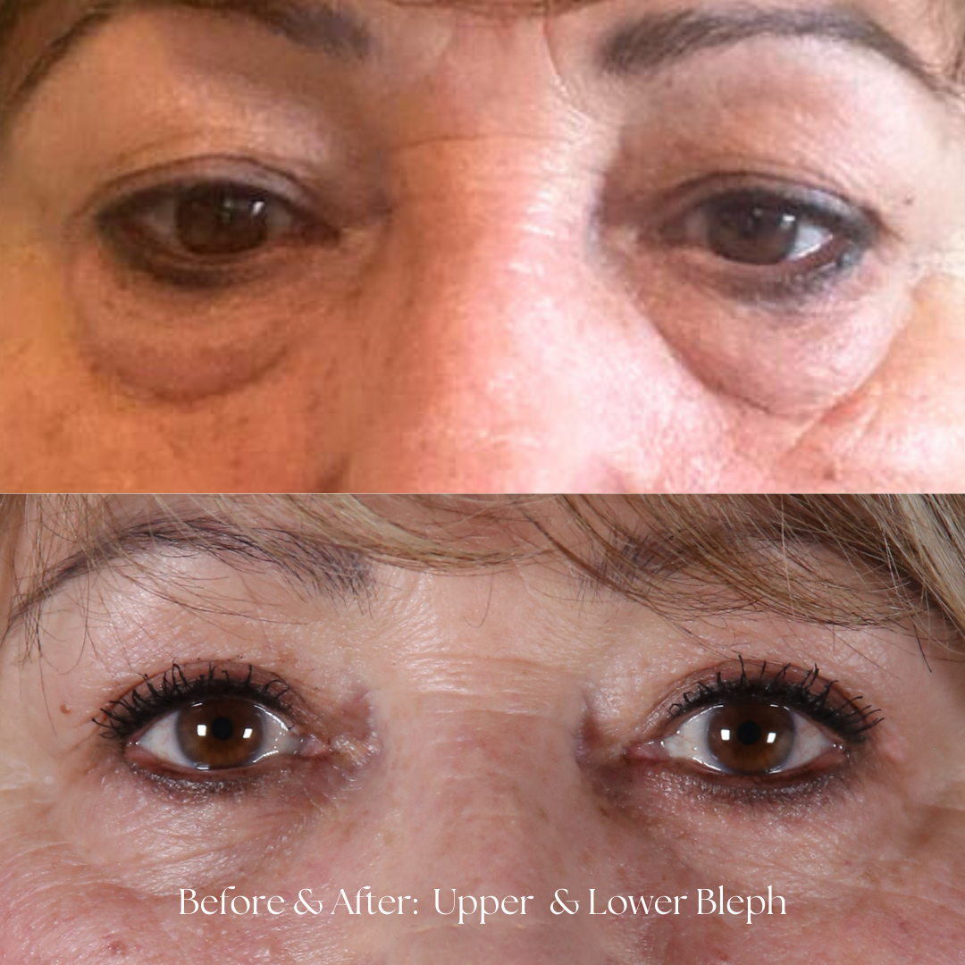 Eyelid Lift Before & After