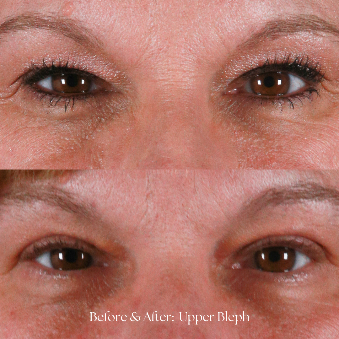 Eyelid Lift Before & After