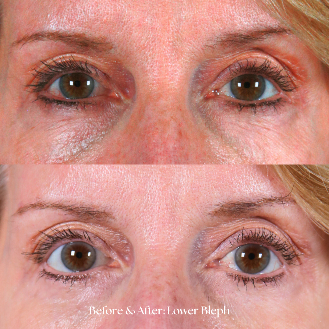 Eyelid Lift Before & After