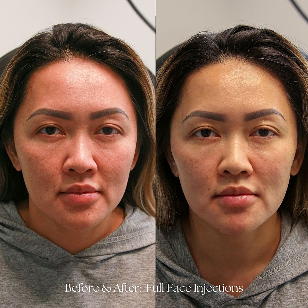 Before and after full face injections comparison.