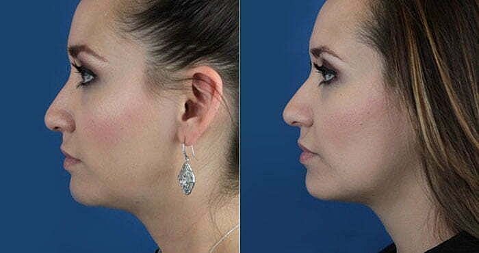 Profile comparison of a woman's face.