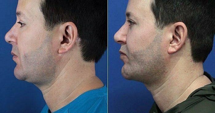 Before and after profile comparison of facial appearance.