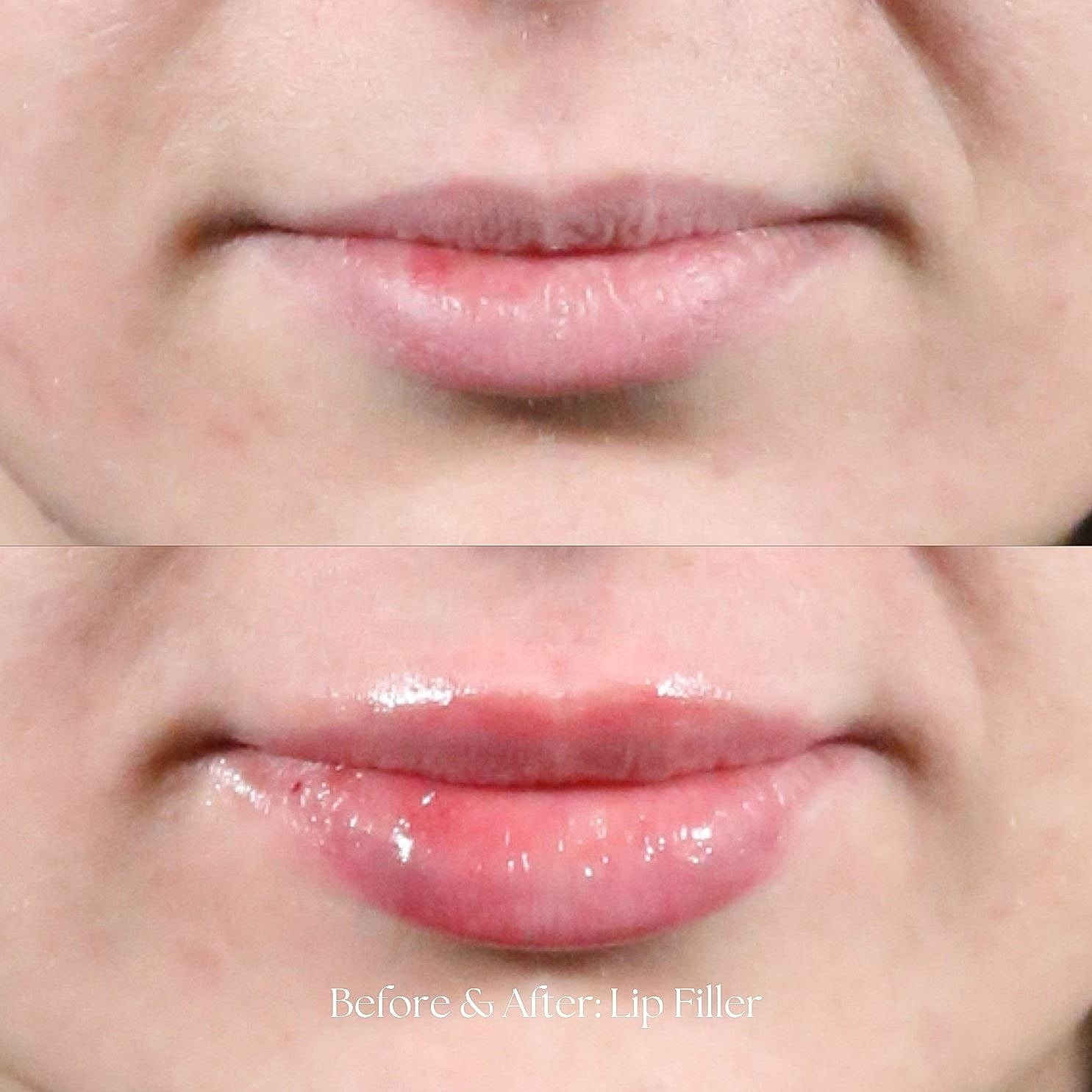 Lip filler transformation before and after photos.