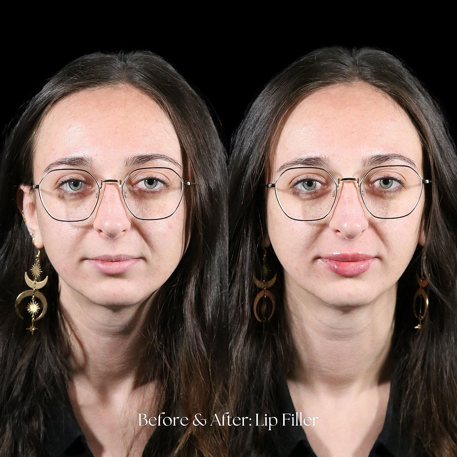 Before and after lip filler transformation comparison.