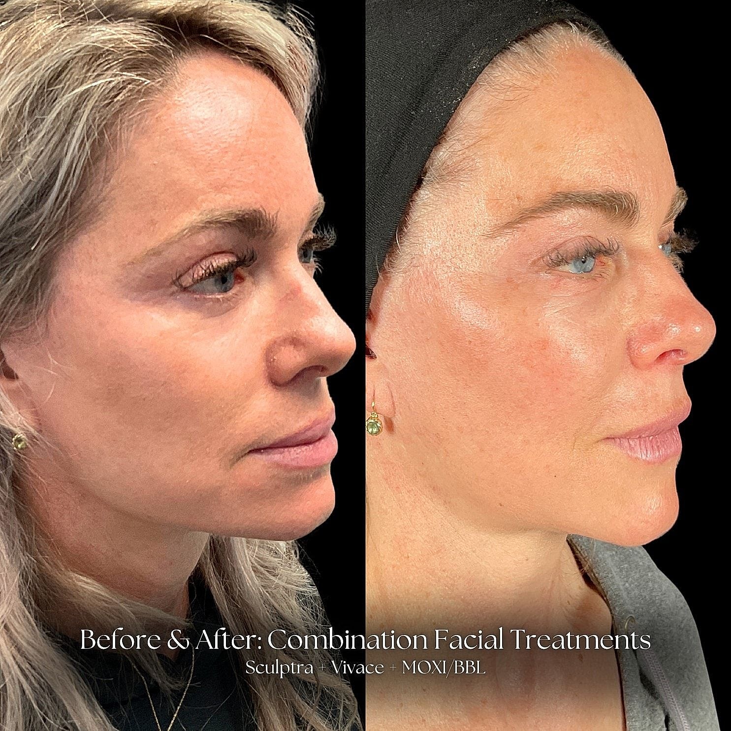 Before and after facial treatment results