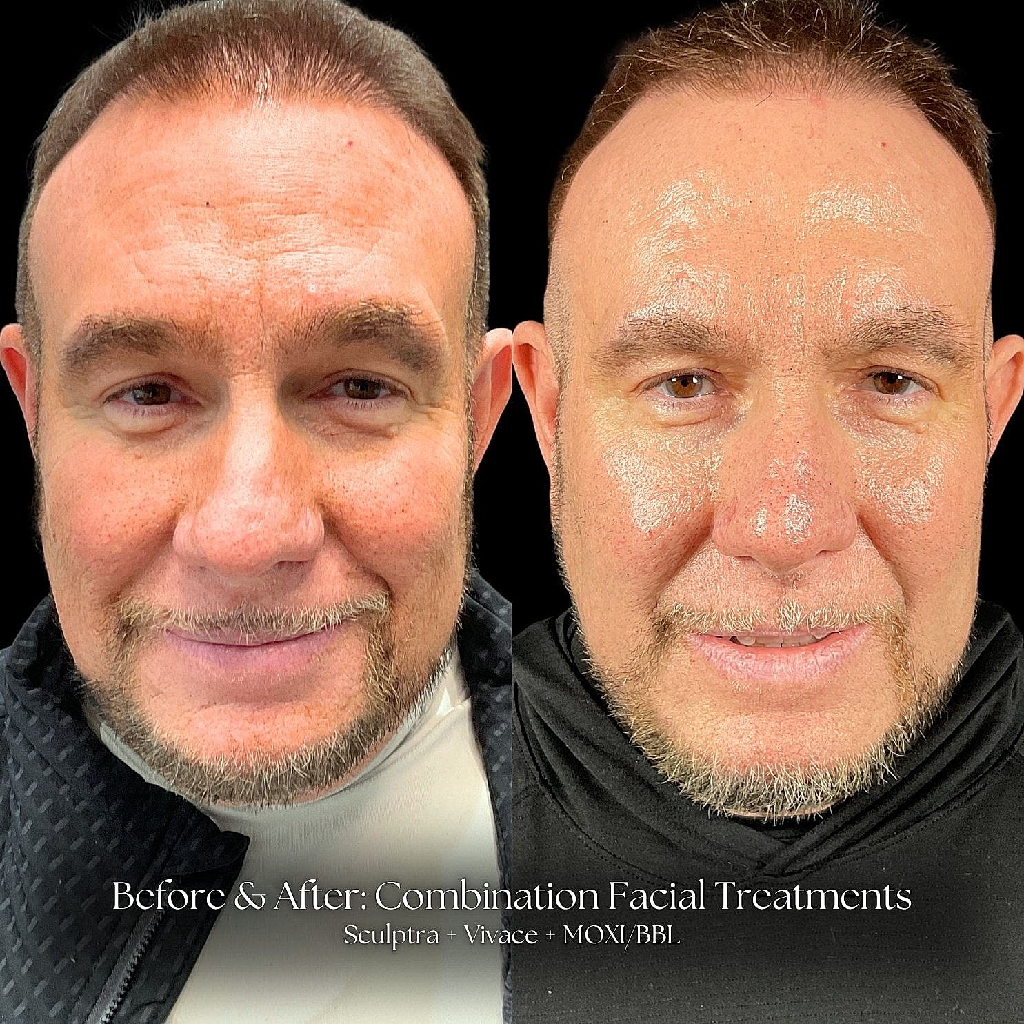 Before and after facial treatment comparison image