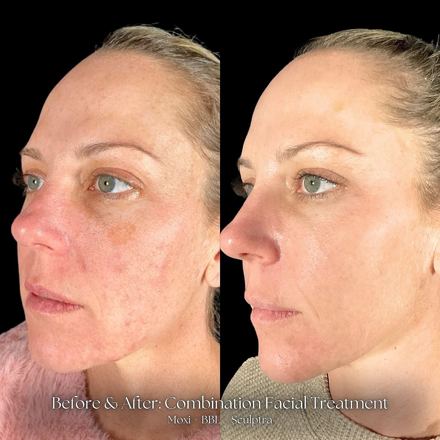 Facial treatment before and after comparison image.