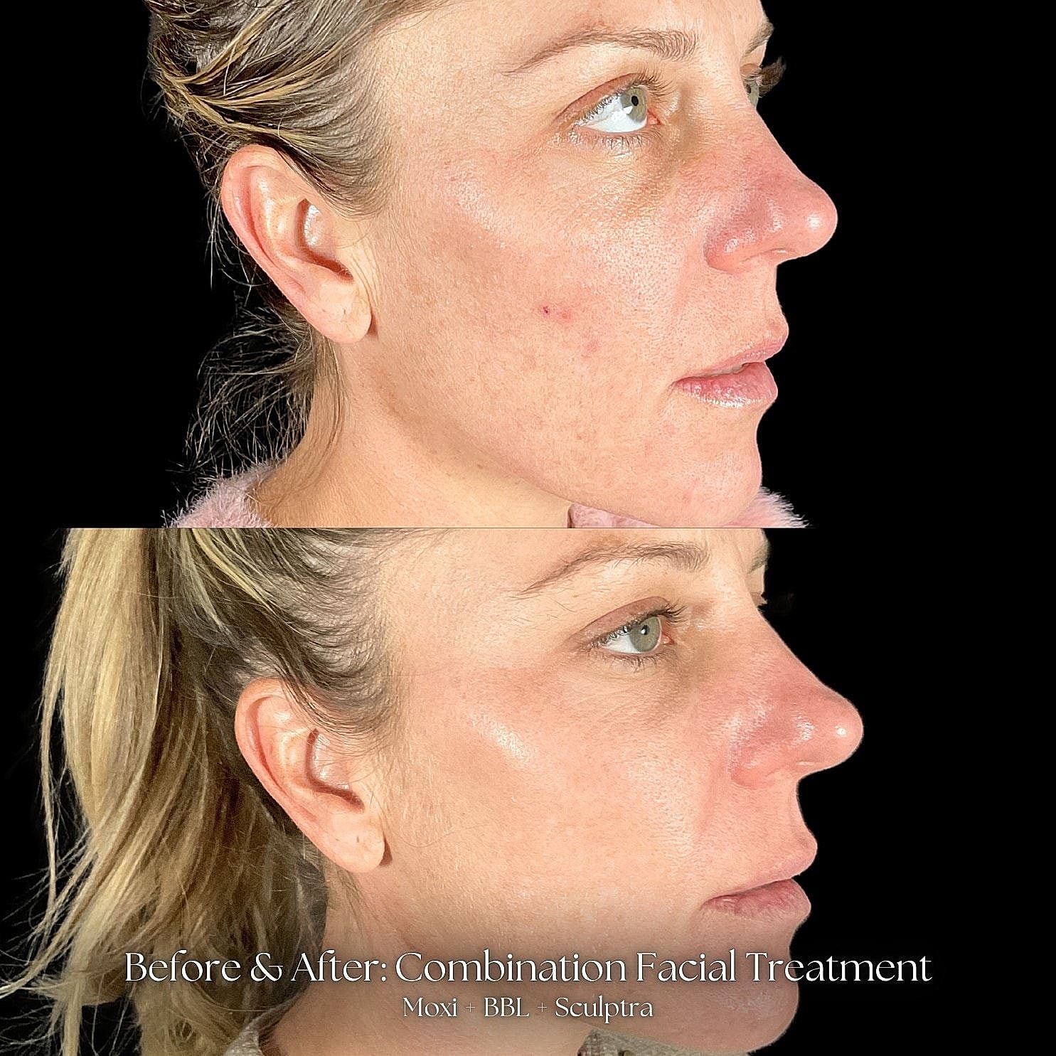 Before and after combination facial treatment results.
