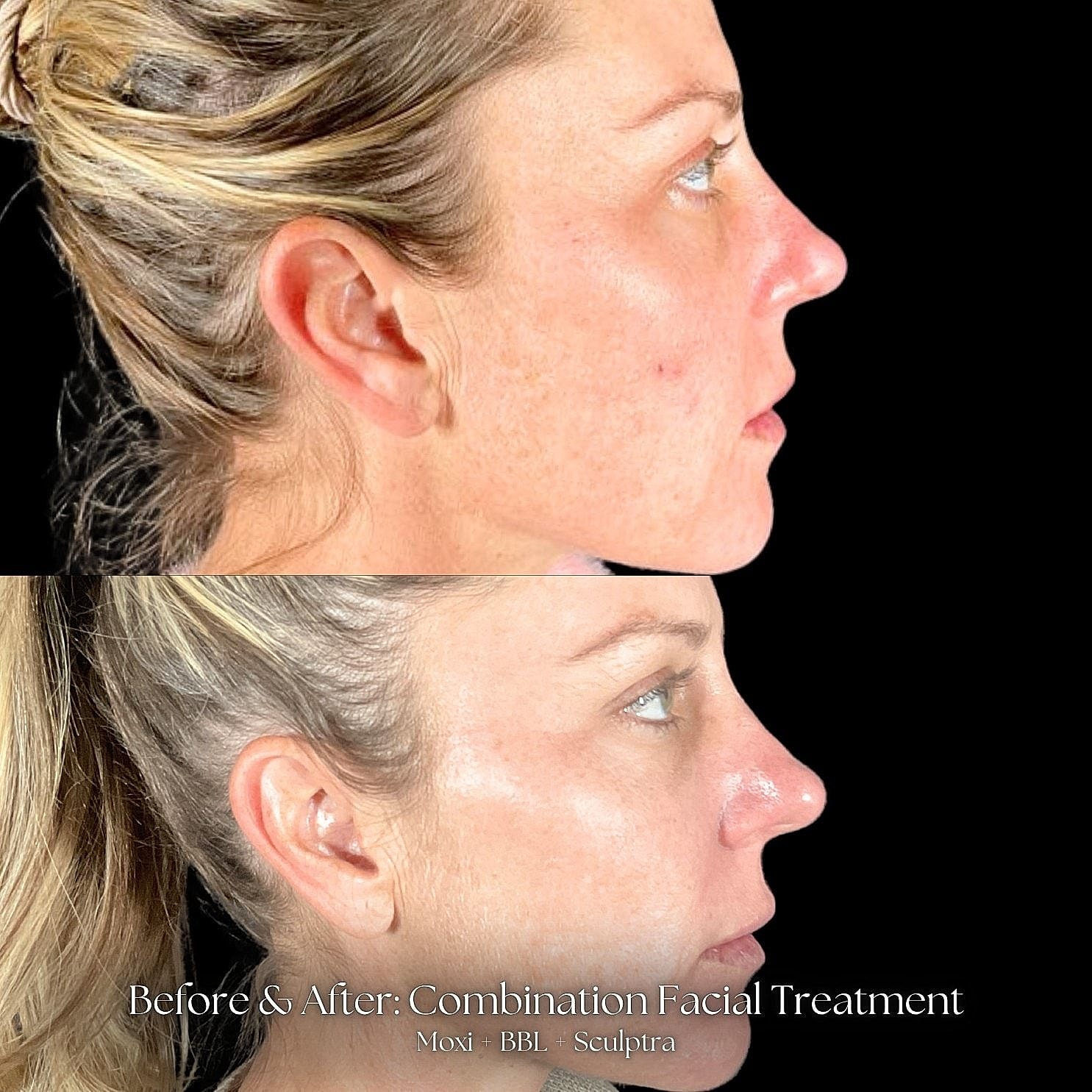 Before and after facial treatment comparison.
