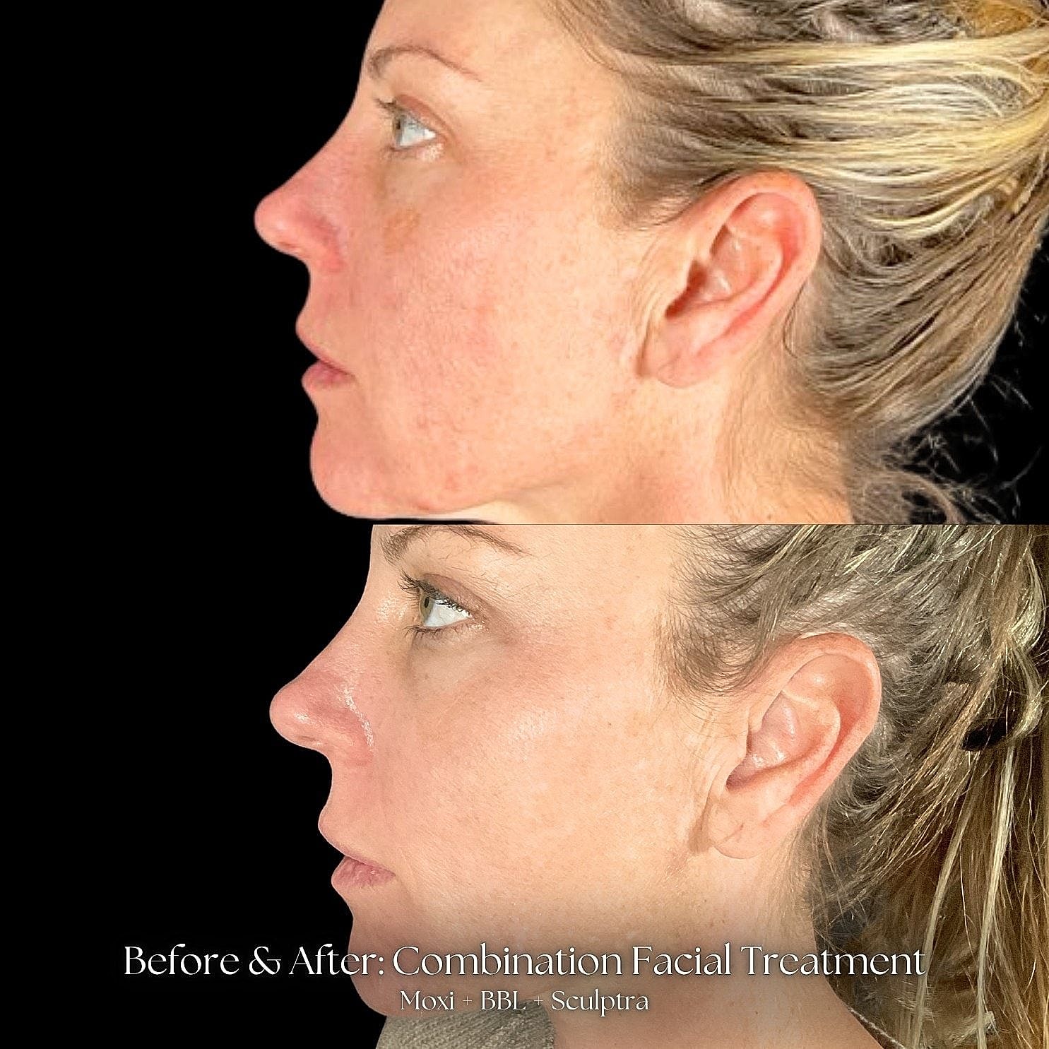 Before and after facial treatment comparison photo.