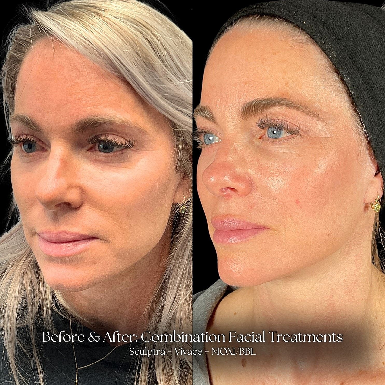 Before and after facial treatment comparison